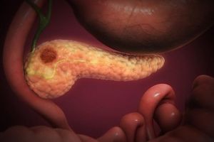 Cancerul de pancreas – factori de risc, diagnostic, tratament