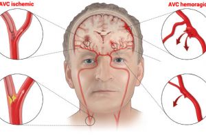 Prof. dr. Natan Bornstein: ”Oamenii neagă existenţa unui AVC, nu cunosc simptomele”