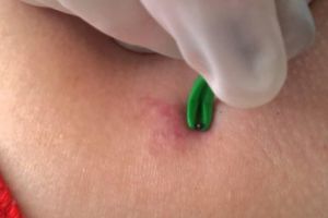 Tot mai mulţi cu boala Lyme. Ultimul caz, la un copil de cinci ani din Piteşti!