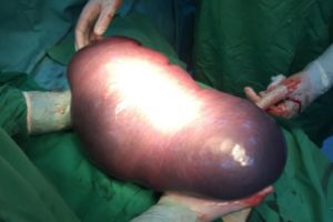 Splina de 6,5 kilograme, operata la Spitalul Judetean din Baia Mare