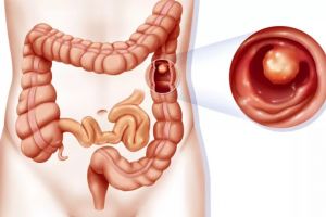 Polipii – simptome, riscuri şi tratament. Când să ne temem de iminenţa unui cancer