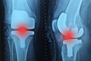 Nou! Consultaţii în specialitatea ortopedie şi traumatologie, la Neuromed