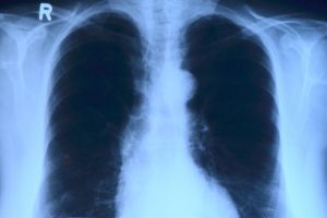 Program gratuit de depistare a tuberculozei în 5 judeţe din Transilvania