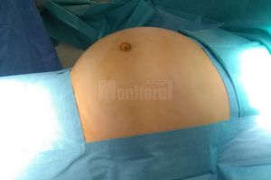 Tumoră de 5,2 kg, extirpată ieri cu succes unei paciente de 62 de ani, la Spitalul de ...