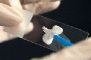 Screening gratuit pentru cancerul de col uterin la Spitalul Municipal Timişoara. Ce condiţii trebuie îndeplinite