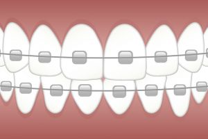Tratamentul ortodontic – când şi de ce avem nevoie de el?