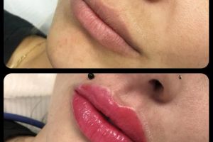 Măriri de buze şi proceduri de înfrumuseţare, efectuate ilegal în Suceava de o clinică ...