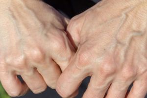 Ţi se văd venele prin piele? Când trebuie să te îngrijorezi