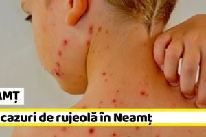 NEAMȚ: Noi cazuri de rujeolă în Neamţ, în această săptămână