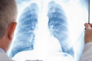 Bolnavii de TBC, căutaţi în Argeş cu o caravană