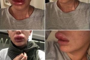 Buzele unei tinere la un pas de a exploda după injecţiile cu Botox. Asistentele au râs de ea când a ajuns la spital