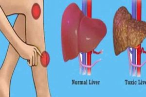 Semne de avertizare ca ficatul este plin de toxine care duc la cresterea in greutate