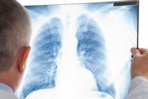 România, pe locul unu în Europa la numărul cazurilor de tuberuloză