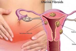 Tratamente Naturiste pentru fibrom