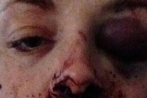 O tânără de 25 de ani, din Botoşani, a fost bătută crunt de trei bărbaţi. Motivul pentru care indivizii au dat în ea ca într-un sac de box (Update)