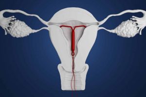 Steriletul hormonal (sau dispozitivul intra-uterin hormonal) – efecte secundare şi contraindicaţii