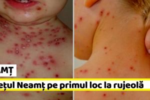 NEAMȚ: Neamţul, din nou pe primul loc în topul judeţelor cu rujeolă, în această săptămână