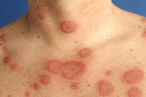 Difteria face ravagii în două localităţi din Ucraina. Evitaţi drumurile în ţara vecină