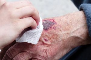 „De la stadiul 2 al escarelor, deja trebuie pansat pacientul şi făcută o barieră între agenţii patogeni şi rană”