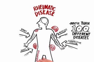 Reumatismul – tot ce trebuie să ştii despre el