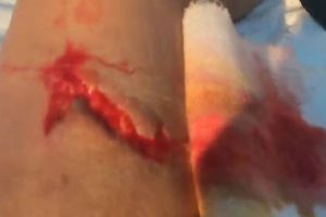 Șocant! Un botoşănean a ajuns la Urgenţe cu piciorul tăiat cu un flex