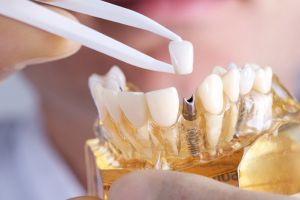 Implantul dentar. Ce este şi când se foloseşte