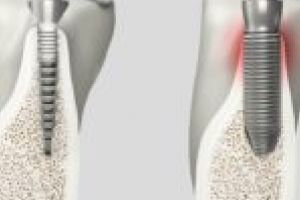 Sistemul de implanturi cu ultrasunete REX, pentru prima oară în România!