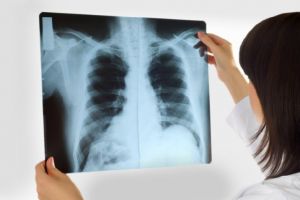 Ce trebuie să ştii despre tuberculoza în SIDA