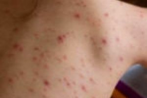 Pericol major! Încă 76 de cazuri de rujeolă, confirmate în ultima săptămână!