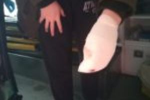 I-a explodat petarda în mână. Tânăr ajuns la Spitalul din Caransebeş