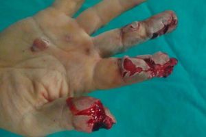 Viceprimarul Erwin Albu propune interzicerea petardelor în Codlea