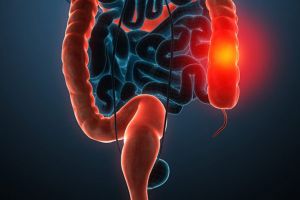 Screening de cancer colorectal la Borsec