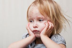 Noi cazuri de rujeolă, confirmate în ultimele trei săptămâni, la Braşov