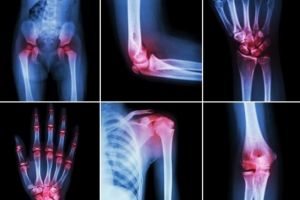 Diferenţele dintre artroză şi artrită şi cum se pot identifica fiecare