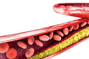 Ateroscleroza coronariană – Cum ţinem sub control principala afecţiune ce poate duce la infarct miocardic