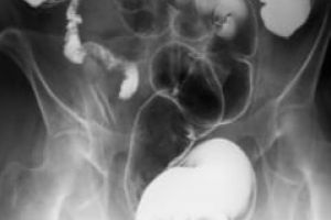 Ce este boala diverticulară colonică