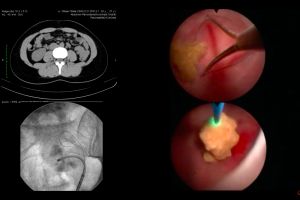 Atenţie la infecţiile urinare. Vezi cum le poţi preveni