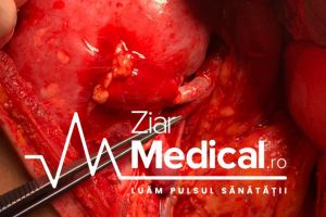 Transplantul renal: când se face, cât este timpul de aşteptare şi care sunt riscurile procedurii chirurgicale