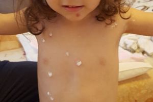 Cazuri de varicelă depistate în mai multe grădiniţe şi şcoli din Arad