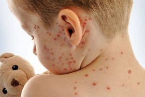 Satu Mare, primul loc la îmbolnăvirea cu un virus ce poate fi mortal