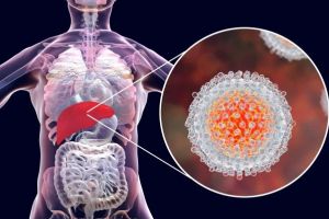 Ce este  hepatita? Ce înseamnă viral?