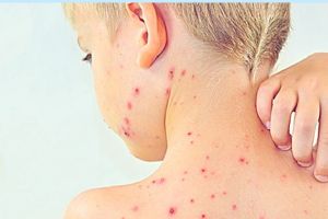 Rujeola se extinde. Noi cazuri confirmate la Satu Mare