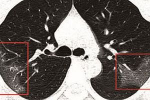 Cum arată radiografia pulmonară a unei tinere cu coronavirus. Medicii, uluiţi de viteza cu care virusul înaintează în organism
