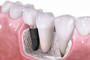 Iată 3 motive pentru care un implant dentar este soluţia optimă pentru tine!