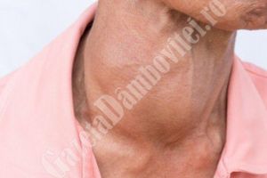 Medicamentul vital al bolnavilor de tiroidă, dispărut din farmacii