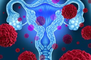 Cancerul de col uterin