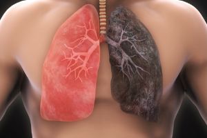 Cancerul pulmonar – Care sunt simptomele acestuia, cum îl putem preveni şi trata