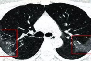Aşa arată plămânii unei persoane infectate cu coronavirus. Radiografia care i-a şocat pe medici