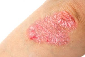Ce este psoriazisul? Cauze, simptome, tratament