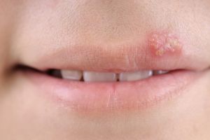 Virusul herpes – Totul despre herpesul oral si herpesul genital